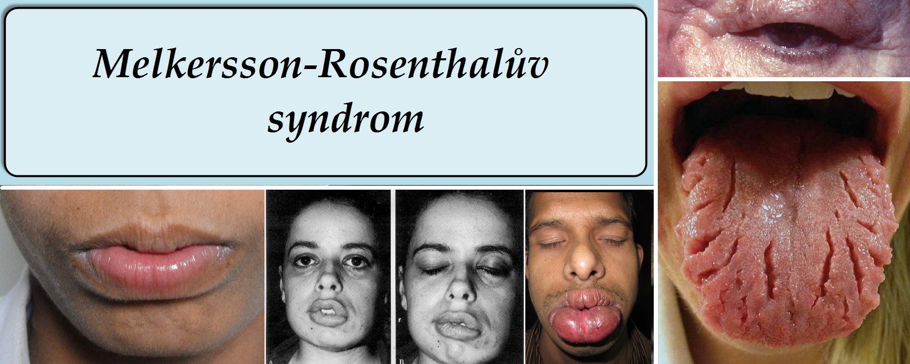 melkersson rosenthaluv syndrom priznaky projevy symptomy pricina lecba