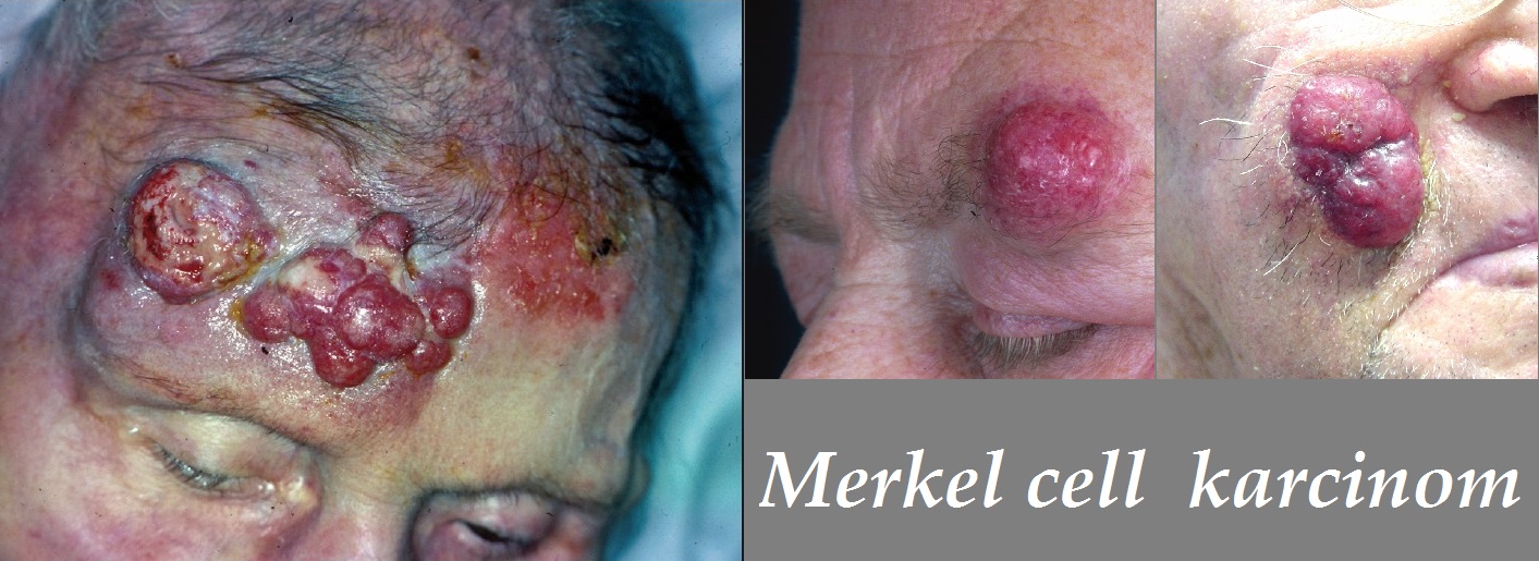 merkel cell karcinom priznaky projevy symptomy obrazek fotografie