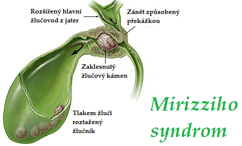 mirizziho-syndrom-priznaky-projevy-symptomy