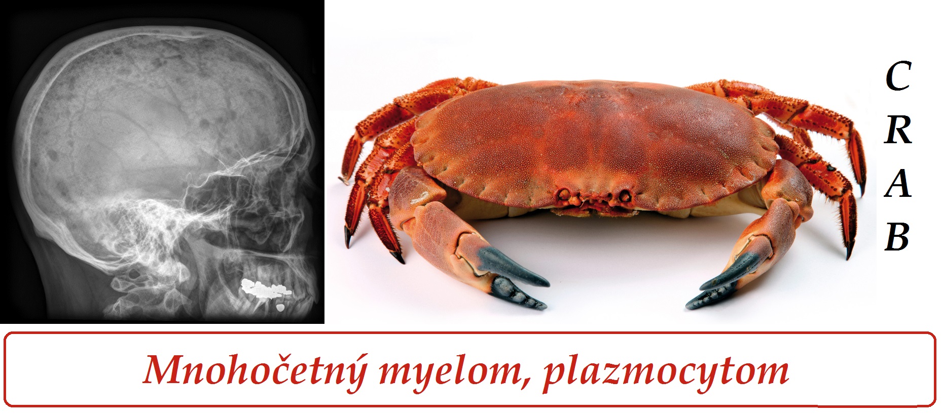 mnohocetny-myelom-plazmocytom-priznaky-projevy-symptomy