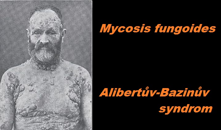 mycosis-fungoides-alibertuv-bazinuv-syndrom-priznaky-projevy-syndromy