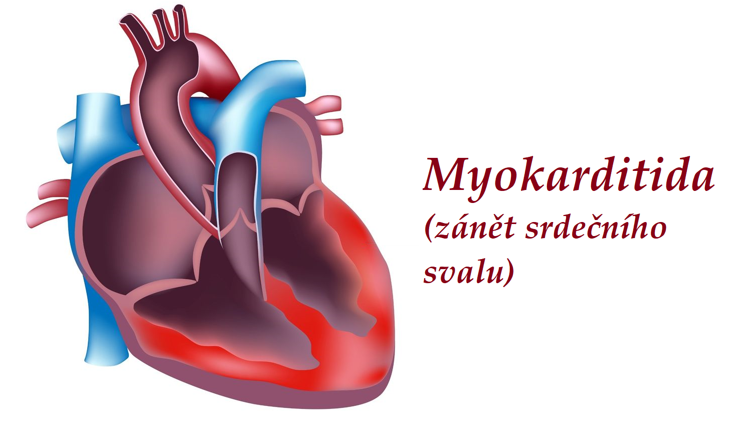 myokarditida zanet srdecniho svalu priznaky projevy symptomy pricina lecba