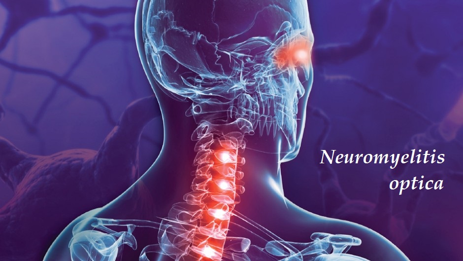 Neuromyelitis optica příznaky projevy symptomy příčina léčba diagnostika vyšetření