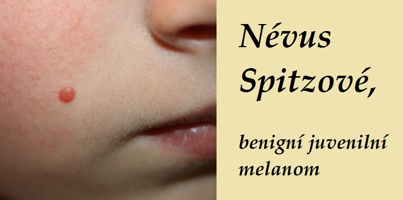 nevus-spitzove-benigni-juvenilni-melanom-priznaky-projevy-symptomy