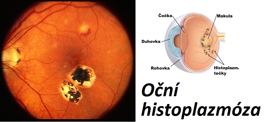 ocni-histoplazmoza-priznaky-projevy-symptomy