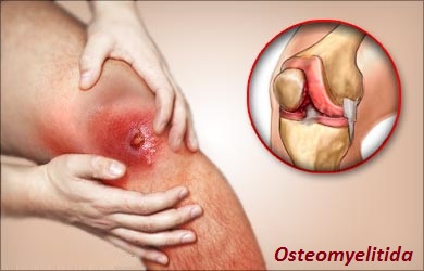 osteomyelitida-osteomyelitis-priznaky-projevy-symptomy