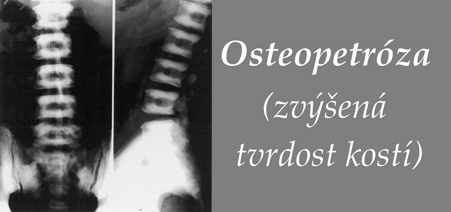 osteopetroza-priznaky-projevy-symptomy