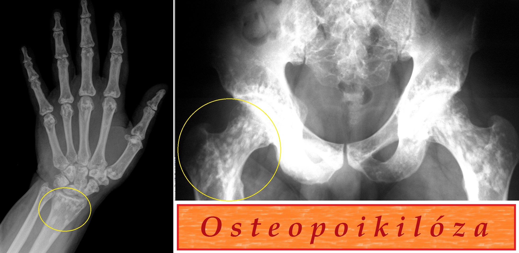 osteopoikilosa-priznaky-projevy-symptomy