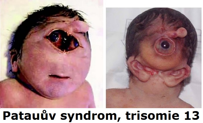 patauuv-syndrom-trisomie-13-chromozomu-priznaky-projevy-symptomy-99