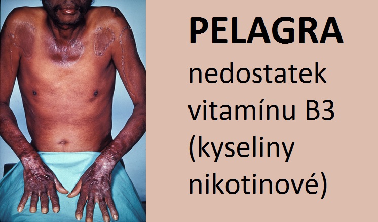 pelagra-hypovitaminoza-avitaminoza-B3-nedostatek-kyseliny-nikotinove-priznaky-projevy-symptomy