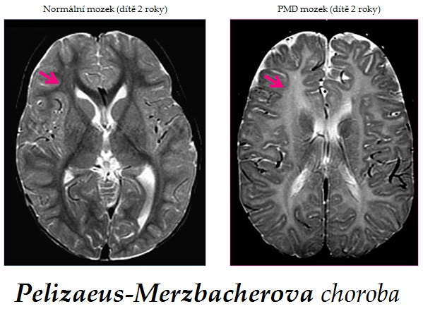 pelizaeus merzbacherova choroba priznaky projevy symptomy