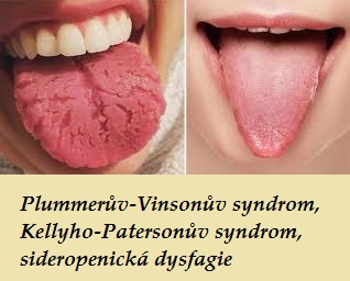 plummeruv vinsonuv syndrom kellyho patersonuv syndrom sideropenicka dysfagie priznaky projevy symptomy