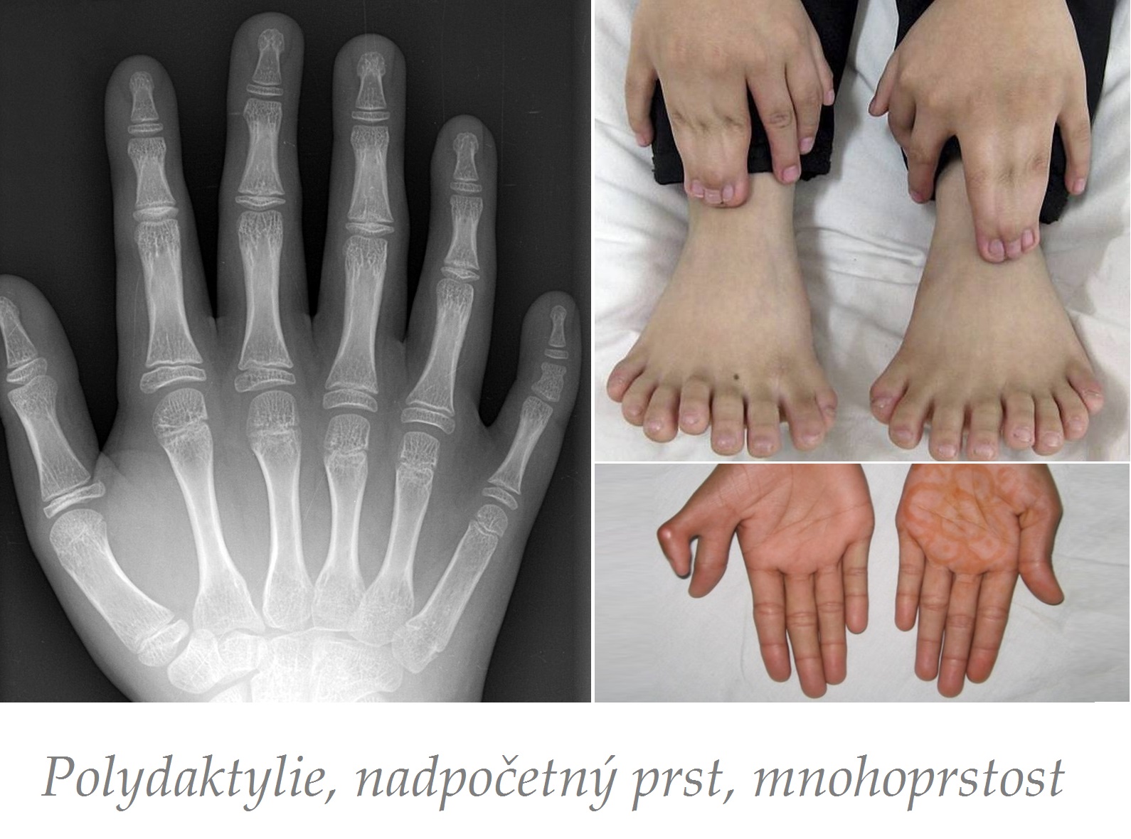 polydaktylie nadpocetny prst mnohoprstost priznaky projevy symptomy