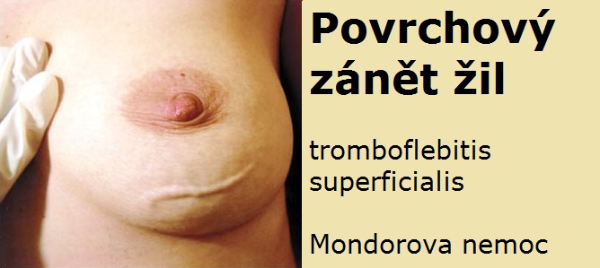 povrchovy-zanet-zil-thrombophlebitis-superficialis-priznaky-projevy-obrazek-fotografie-66