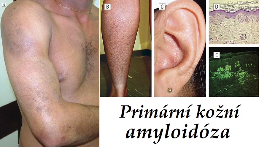primarni kozni amyloidoza priznaky projevy symptomy