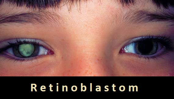 retinoblastom-priznaky-projevy-symptomy