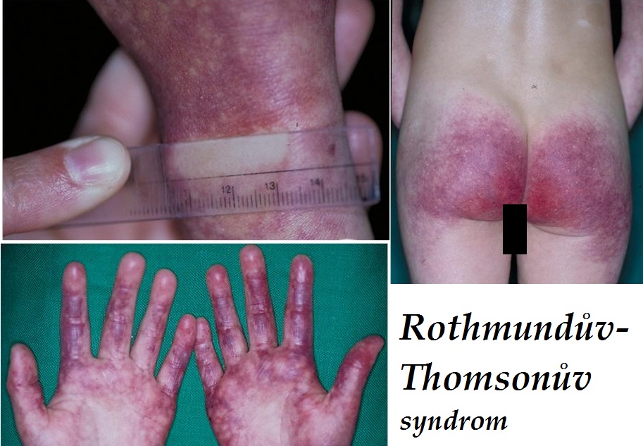 rothmunduv-thomsonuv-syndrom-priznaky-projevy-symptomy copy