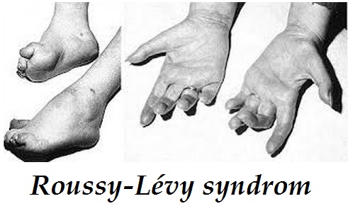 roussy-levy-syndrom-priznaky-projevy-symptomy