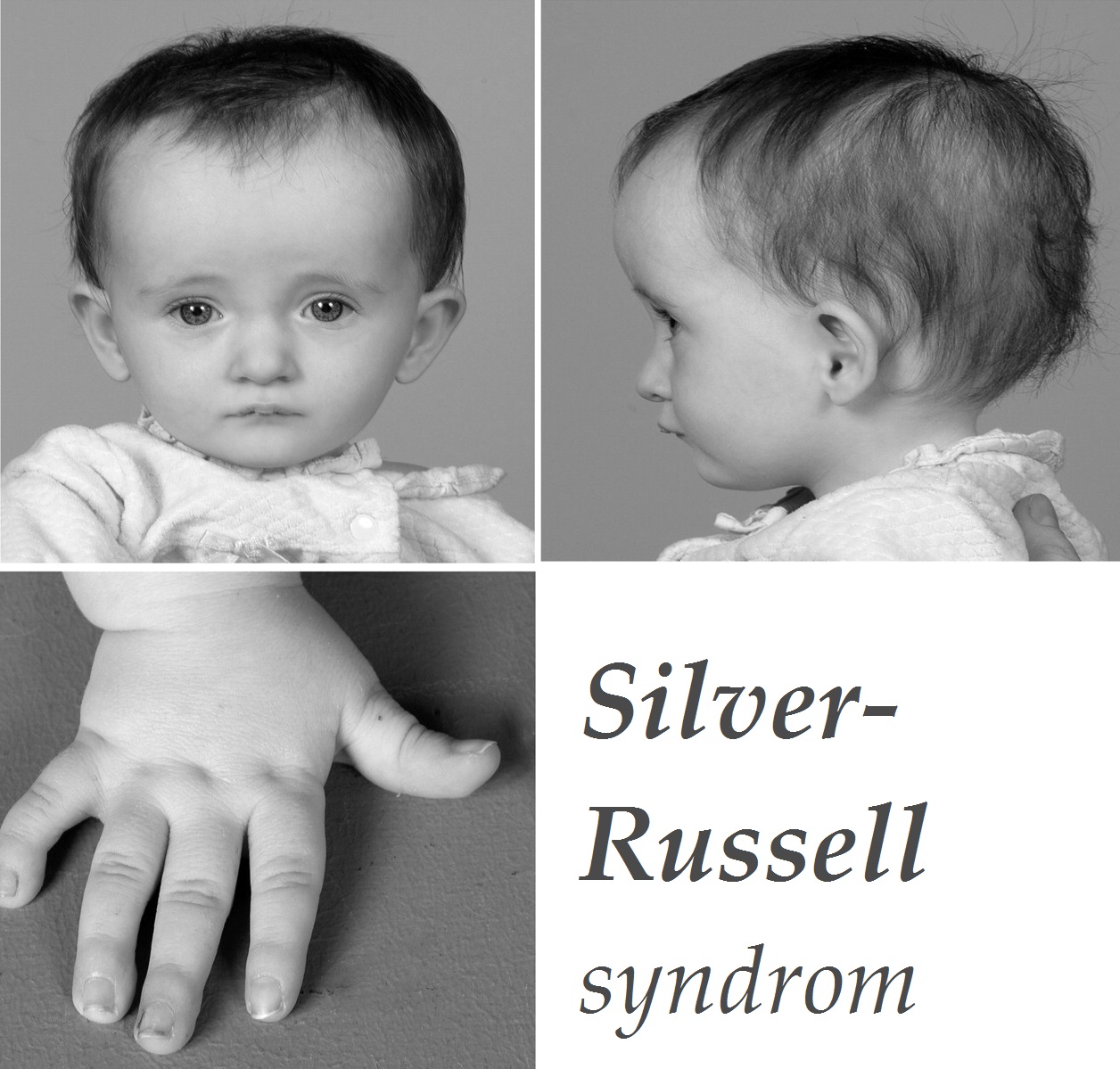 silver-russell-syndrom-priznaky-projevy-symptomy