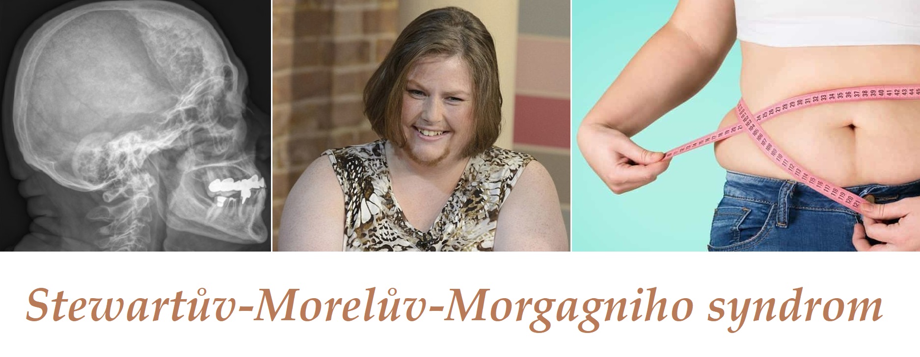 Stewartův-Morelův-Morgagniho syndrom – příznaky, projevy, symptomy, příčina, léčba