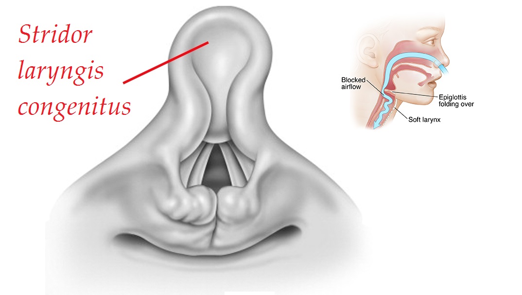 stridor laryngis congenitus priznaky projevy symptomy pricina lecba
