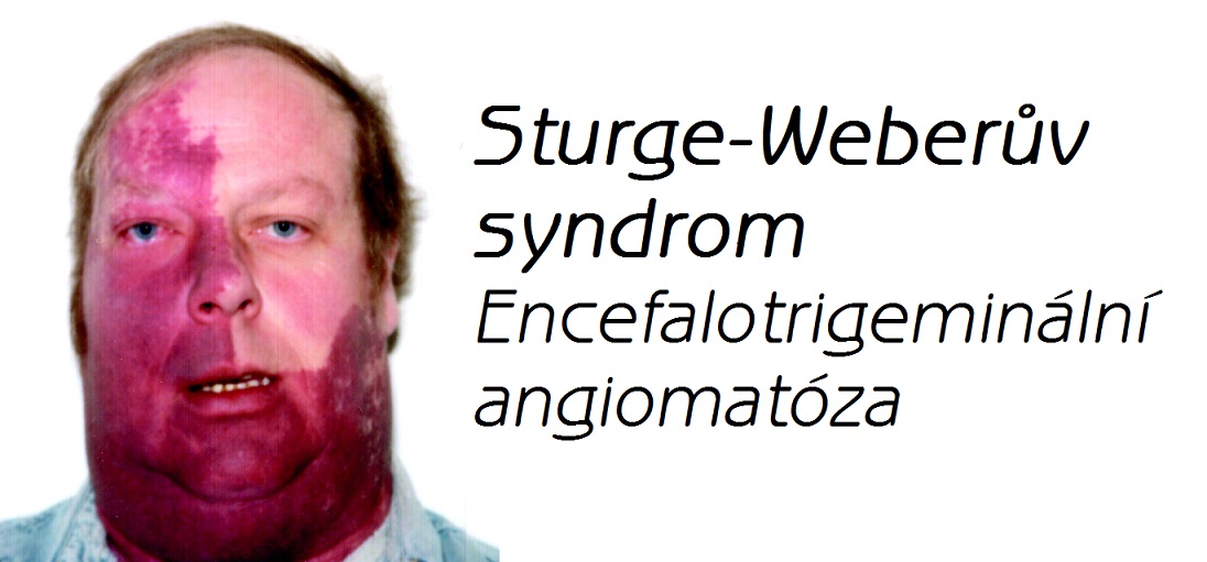 sturge-weberuv-syndrom-encephalotrigeminalni-angiomatoza-priznaky-projevy-symptomy