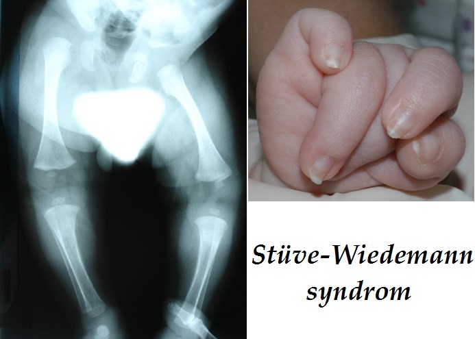 stuve-syndrom-stuve-wiedemann-syndrom-priznaky-projevy-symptomy
