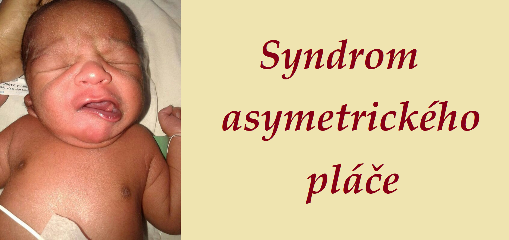 Syndrom asymetrickéh pláče příznaky projevy příčina léčba