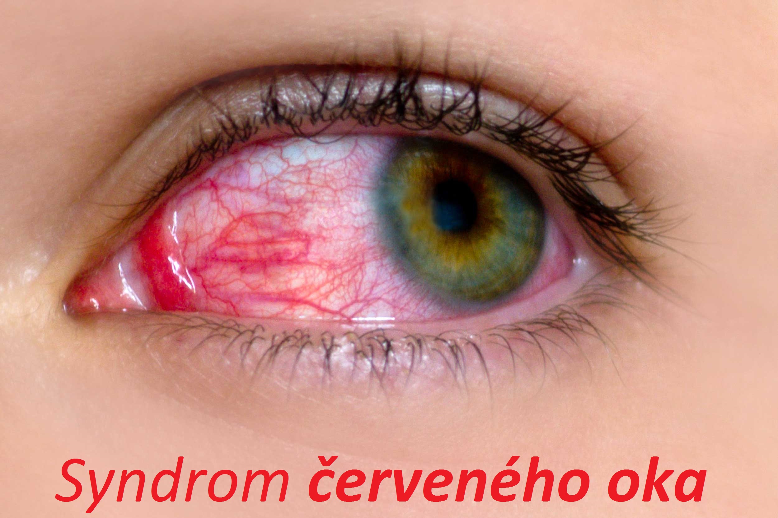 syndrom cerveneho oka priznaky projevy symptomy pricina lecba
