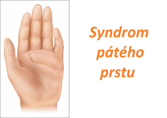 syndrom pateho prstu priznaky projevy symptomy pricina fotografie obrazek