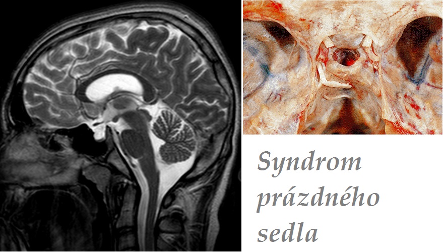 syndrom-prazdneho-sedla-empty-sella-syndrome-priznaky-projevy-symptomy