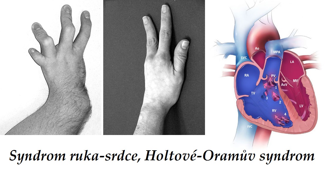 syndrom ruka srdce holtove oramuv syndrom holt oram syndrome