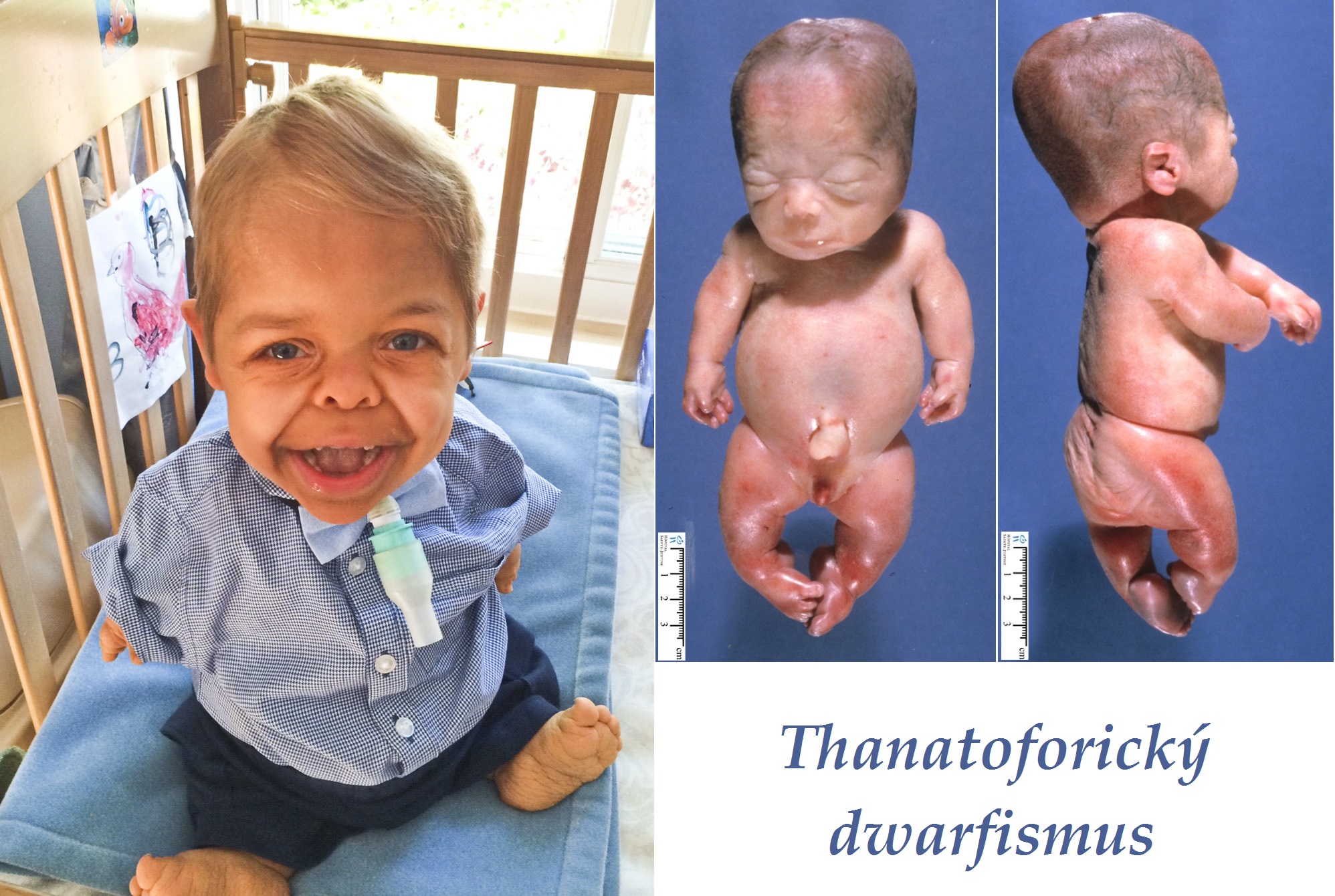 thanatoforicky dwarfismus priznaky projevy symptomy pricina lecba 1