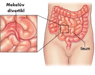 meckeluv-divertikl-mekeluv-divertikl-priznaky-projevy-symptomy-2