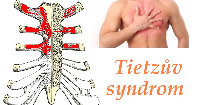 tietzuv-syndrom-priznaky-projevy-symptomy