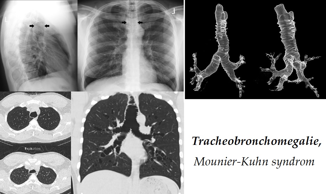 tracheobronchomegalie mounier kuhn syndrom priznaky projevy symptomy
