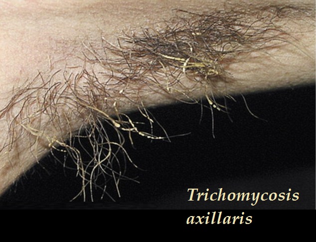 trichomycosis axillaris priznaky projevy symptomy pricina lecba