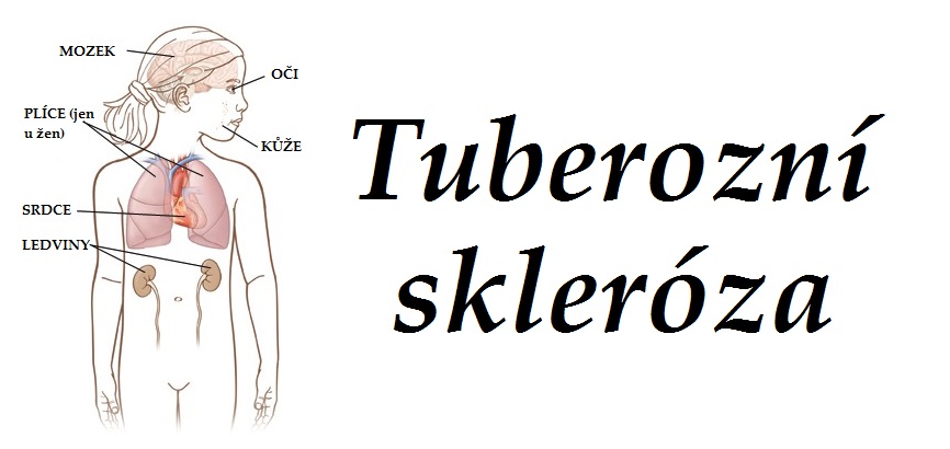 tuberozni-skleroza-priznaky-projevy-symptomy
