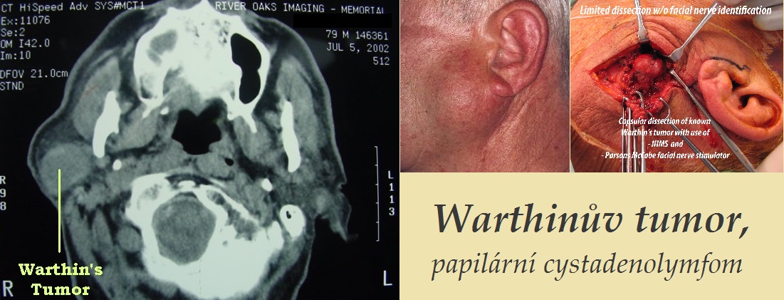 warthinuv tumor papilarni cystadenolymfom priznaky projevy symptomy pricina lecba