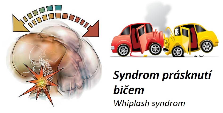 whiplash-syndrom-krcni-patere-prasknuti-bicem-priznaky-projevy-symptomy