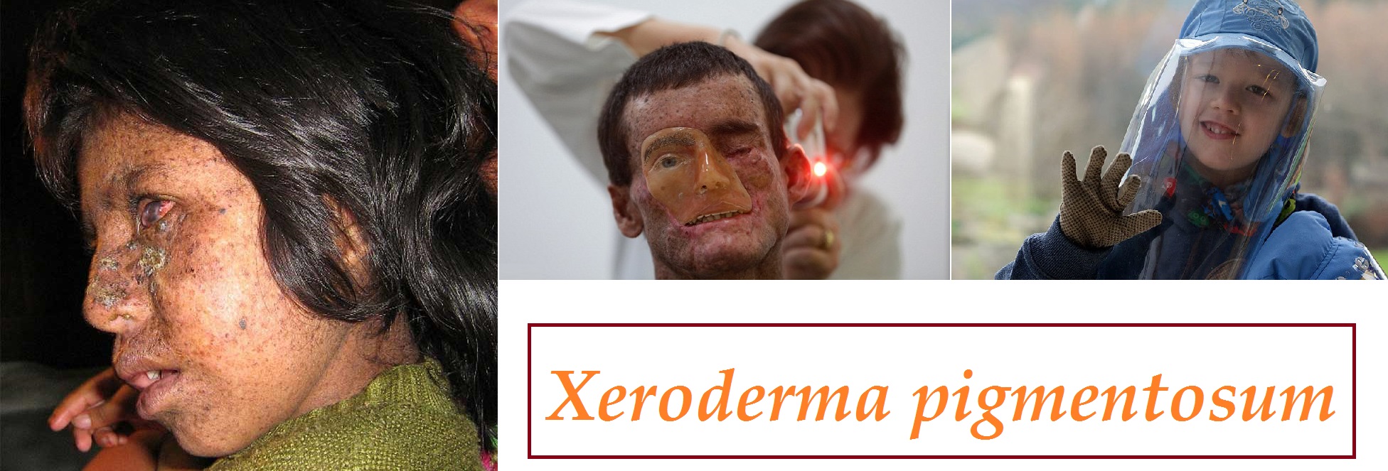 xeroderma pigmentosum fotografie priznaky projevy symptomy pricina lecba obrazek