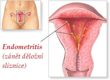 zanet delozni sliznice endometritida endometritis priznaky projevy symptomy