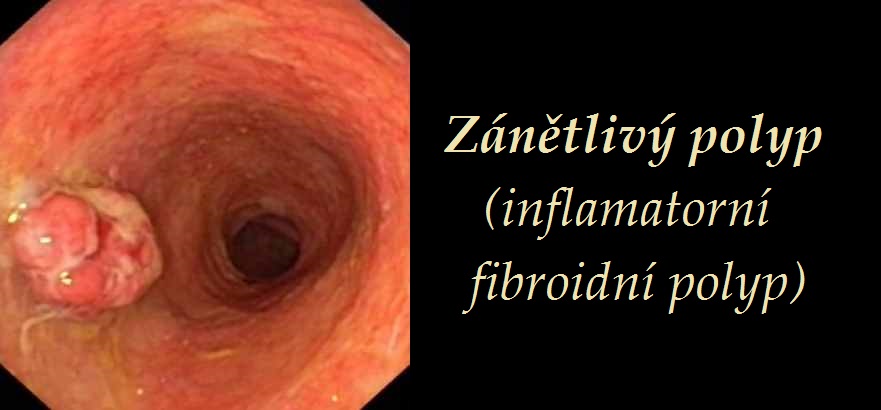 zanetlivy-polyp-inflamatorni-fibroidni-polyp-priznaky-projevy-symptomy
