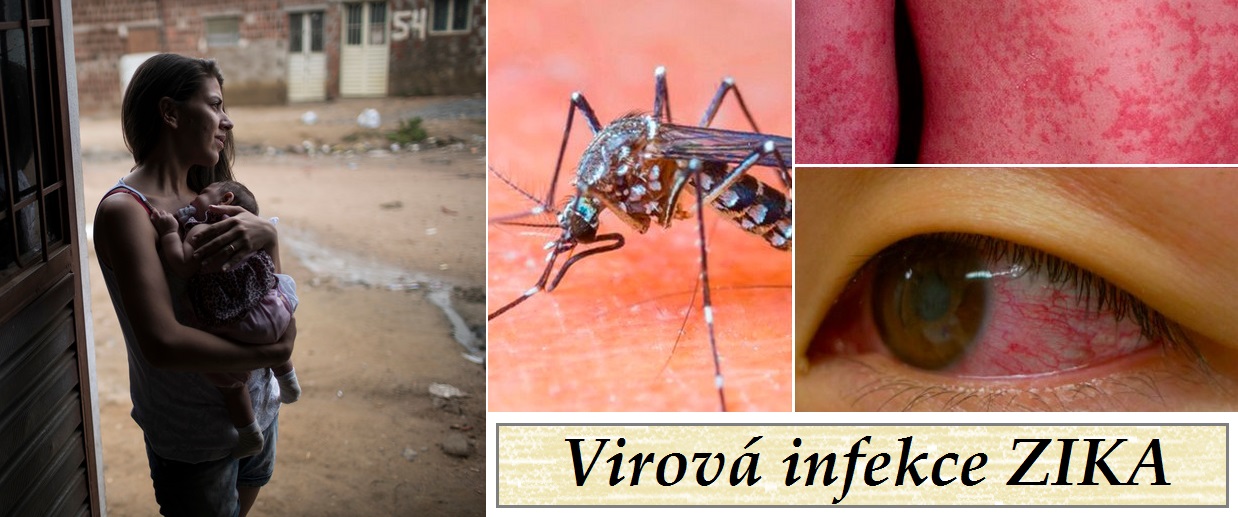 zika virova infekce priznaky projevy symptomy