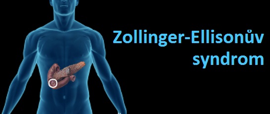 zollinger-ellisonuv-syndrom-priznaky-projevy-symptomy