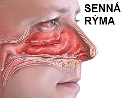 alergicka-rinitida-senna-ryma-priznaky-projevy-symptomy