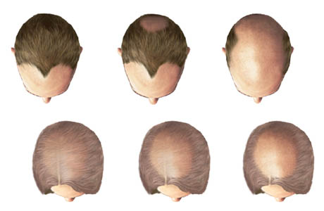 alopecie-plesatost-holohlavost-priznaky-projevy-symptomy-obrazek