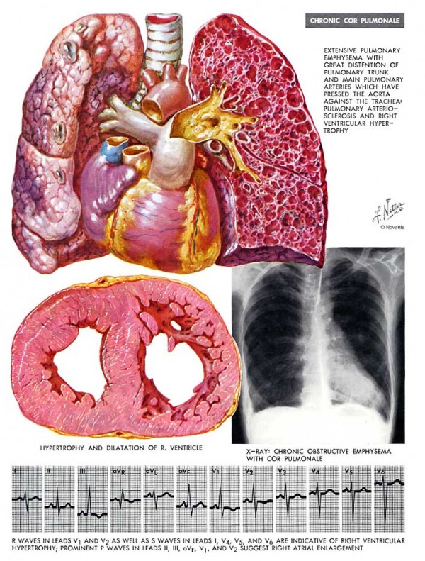 cor-pulmonale-priznaky-projevy-symptomy-obrazek