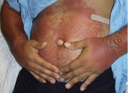 fotoalergicka-dermatitida-priznaky-projevy-symptomy