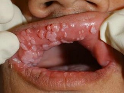 rossz szagú papillomavírus
